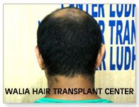 Tim McGraw Hair Transplant - Walia Hair Transplant