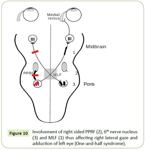 Gaze Palsy in Children: What is Underneath? - A Review Article