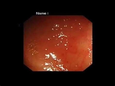 #terminal #ileum #intubation : r/gastroHEPATOLOGY