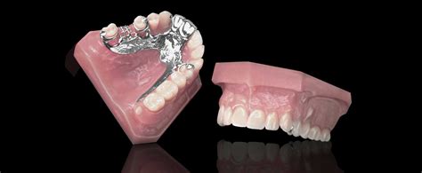 Cast Partial Dentures: All You Need To Know About Cast Partial Dentures