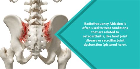 Sacroiliac Joint Radiofrequency Ablation