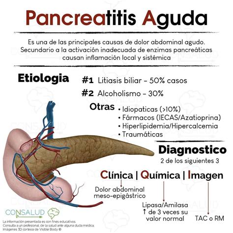 FlashCards #CONSALUD: Pancreatitis aguda ¿Sabes la diferencia entre el signo de Grey Turner y ...