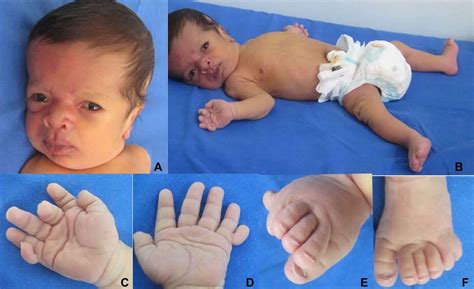 Macrocephaly capillary malformation syndrome causes, symptoms, diagnosis, treatment & prognosis