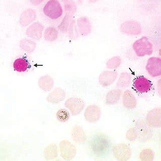 Ring sideroblasts observed on linezolid treatment (arrows); bone marrow... | Download Scientific ...