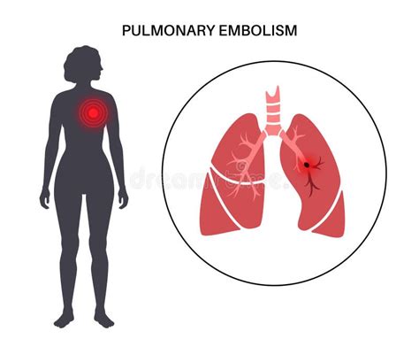 Pulmonary embolism disease stock illustration. Illustration of female ...