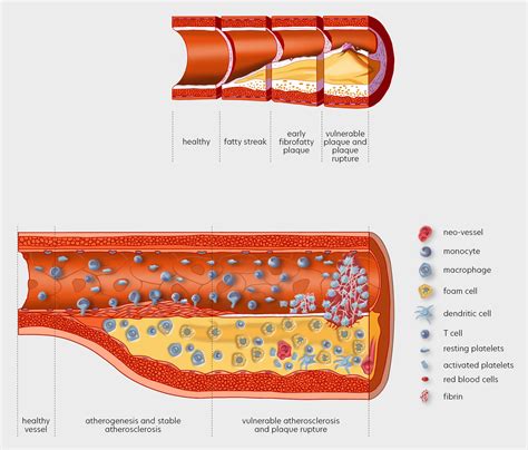 Atherosclerosis and cardiovascular risk – Lipid Tools