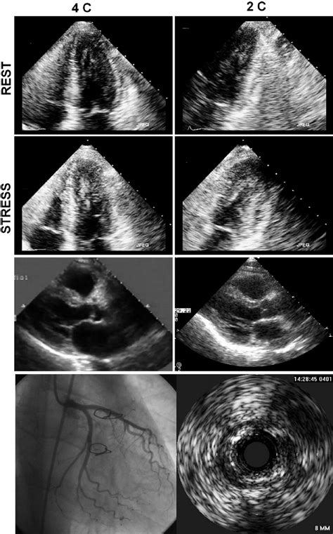 (Top) A representative example of a stress echocardiogram in a... | Download Scientific Diagram