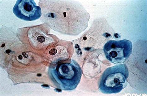 Koilocytes (visibly HPV-infected cells).