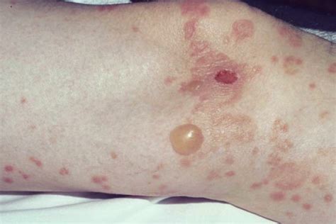 Bullous Pemphigoid - Pictures, Symptoms, Treatment, Causes