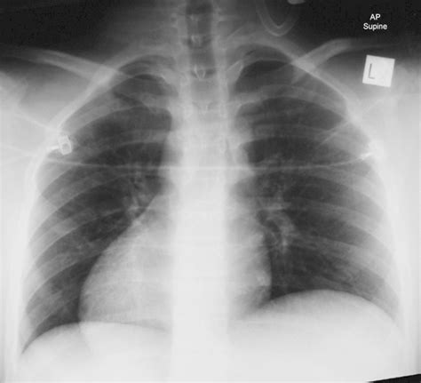 Subsequent chest X-ray with a radiopaque side marker. | Download Scientific Diagram