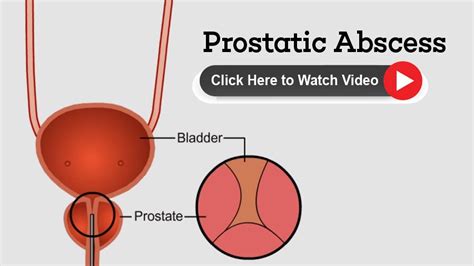 Prostatic Abscess for Patient Education - Health Video | Medindia