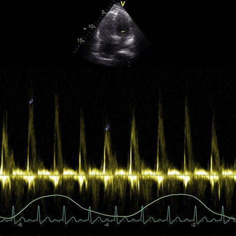 Transthoracic echocardiography (spectral Doppler). Accentuated... | Download Scientific Diagram