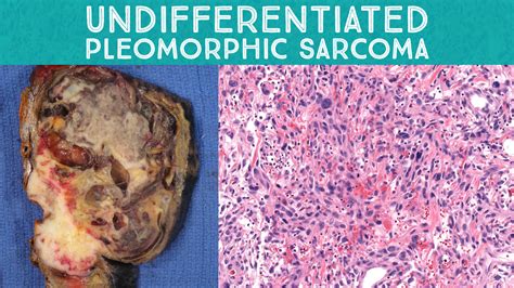 Spindle Cell Neoplasm Pathology 101: Undifferentiated pleomorphic ...