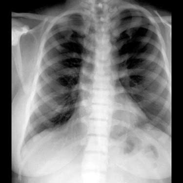 Osteopetrosis | Radiology Key