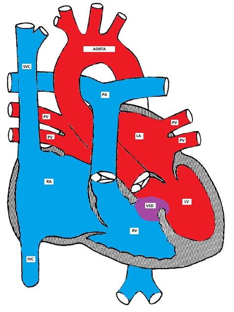 Left-to-Right Shunts