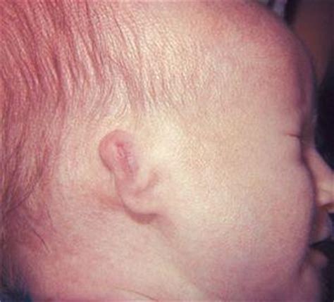 Deafness at birth | Ear, Nose, Throat, and Dental problems articles ...