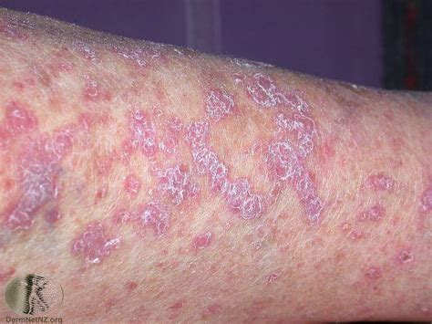 Lichen Planus Treatment - Colorado Springs & Monument, CO