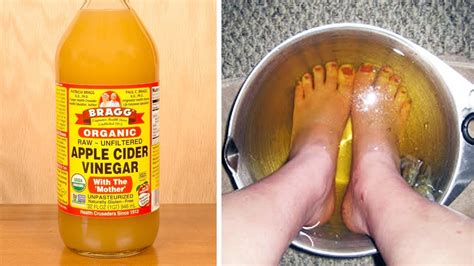 Apple Cider Vinegar For Toenail Fungus - All You Need Infos