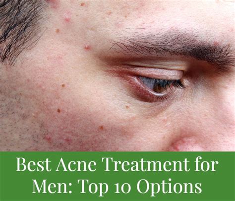 Best Acne Treatment for Men: Top 10 Options - Cushy Spa