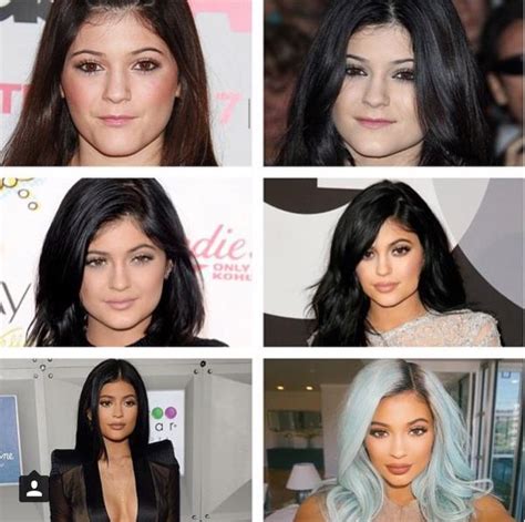 Kylie Jenner Transformation – The White Rooms Clinic