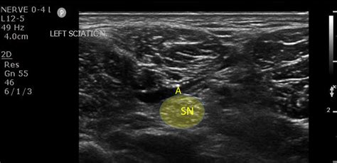 Popliteal Nerve Block Ultrasound