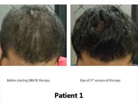 Prp Hair Treatment Side Effects - Doctor Heck