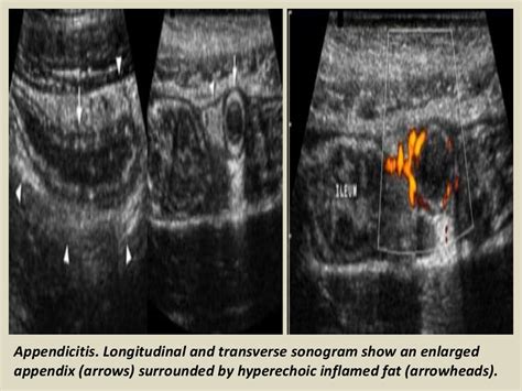 Presentation1.pptx, ultrasound examination of the appendix.