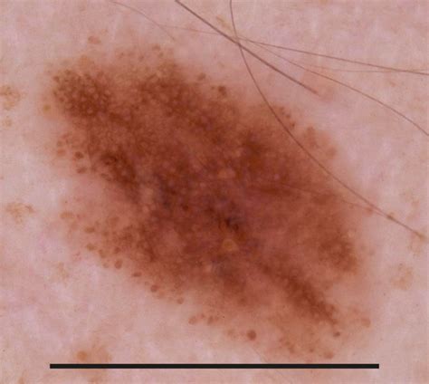 Dermoscopy of Melanocytic Neoplasms: Subpatterns of Dysplastic/Atypical ...