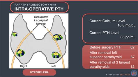 Intraoperative Parathyroid Hormone (PTH) Testing | Dr. Larian