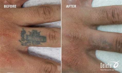 Here is this week's "Before & After" PicoWay laser tattoo removal from ...