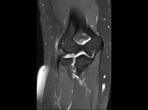 Common extensor tendon tear or elbow - YouTube