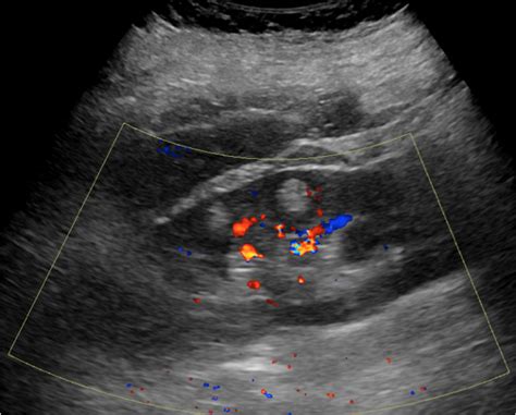 Renal Angiomyolipoma Ultrasound