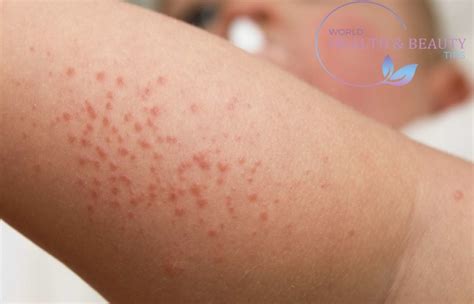 Skin Rash - Description of the elements of the Rash, Types and Treatment