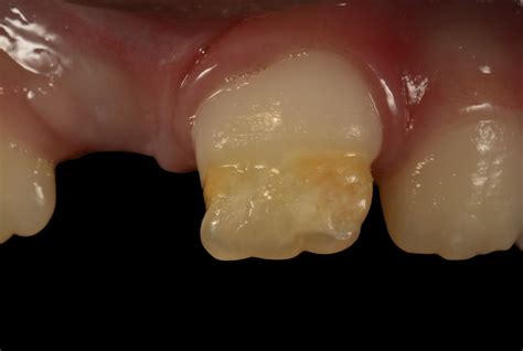 Conservative Management of Hypoplasia after primary tooth trauma