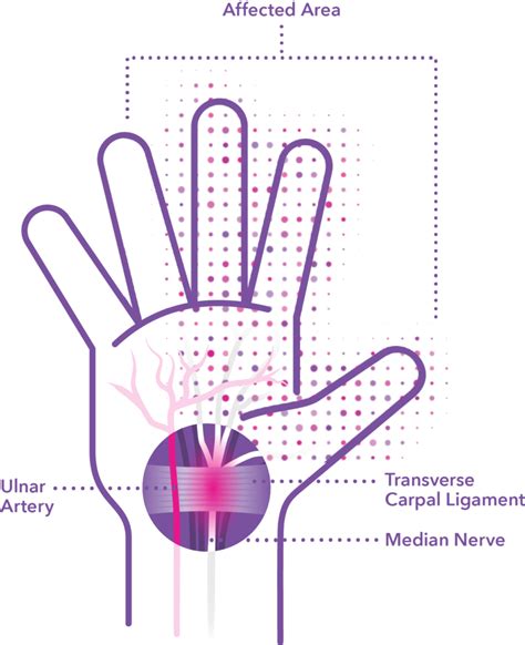 Carpal Tunnel Syndrome: Symptoms and Treatment