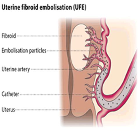 EMBOLISATION FOR UTERINE FIBROIDS - PKLI&RC