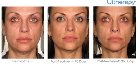 Ultherapy -Ultimate Non-Surgical Facelift -Brow Lift