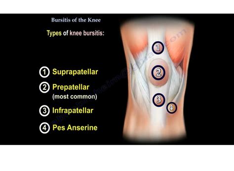 Knee Bursitis Discharge Care What You Need To Know | Sexiz Pix