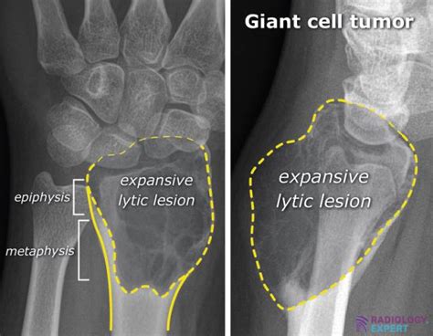 Bone tumours