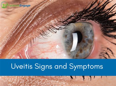 Signs and Symptoms of Uveitis | PatientsEngage