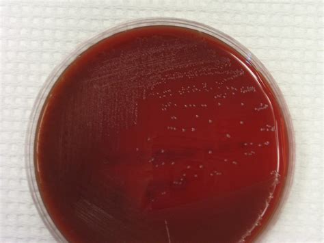 Streptococcus Bovis Cancer