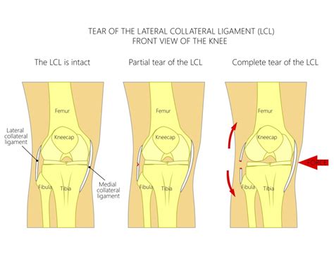 Mcl Knee Injury