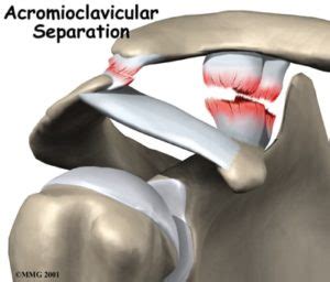 AC Separations- When is Surgery Considered? Video Discussion. - Howard J. Luks, MD