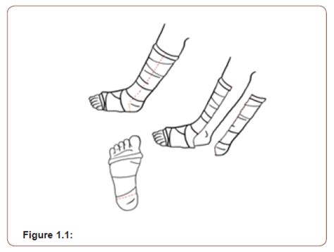 Orthopedic Casting Removal: Quick Techniques | Iris Publishers