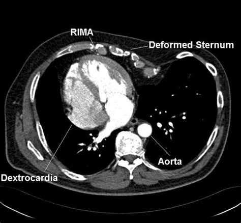 CT scan showing dextrocardia with situs solitus. (RIMA- Right Internal... | Download Scientific ...