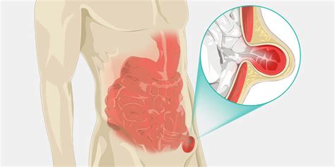 Hernia - The Complete Injury Guide - Vive Health