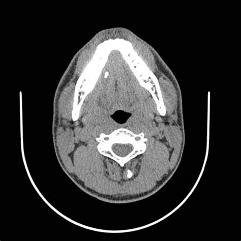 Submandibular duct stone | Radiology Case | Radiopaedia.org | Radiology, Stone, Duct