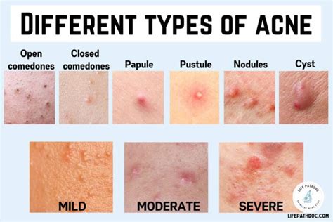 Different Types of Acne (with pictures) & Their Treatment