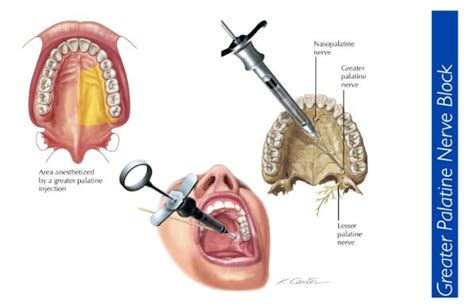 Anterior or Greater Palatine Nerve Block – Local Anesthesia Technique