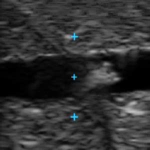 VASCULAR ACCESS ULTRASOUND PHANTOM - VATA